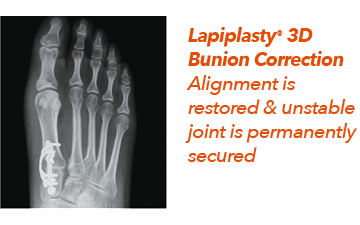 Lapiplasty® 3D Bunion Correction